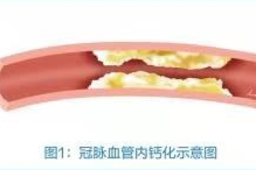 冠状动脉内膜高速旋磨术