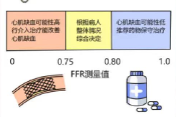 血流储备分数（FFR）