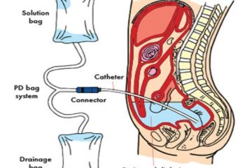 【慢病健康】腹膜透析不容忽视的知识