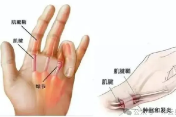 手机刷不停？当心“狭窄性腱鞘炎”