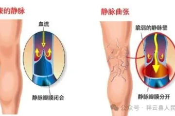 静脉曲张只能一拖再拖？新式微创治疗，或许是你不知道的选项