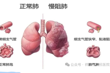 【慢病健康】警惕沉默杀手——慢阻肺
